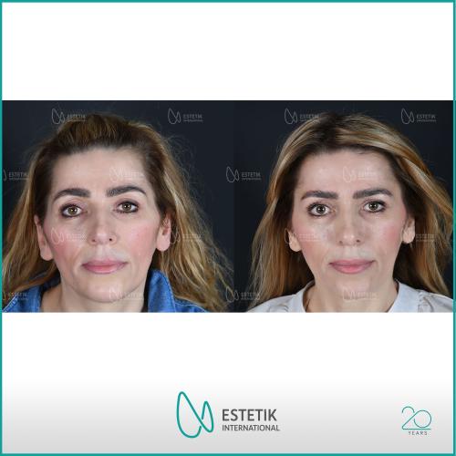 عملية عيون القطة صور قبل وبعد